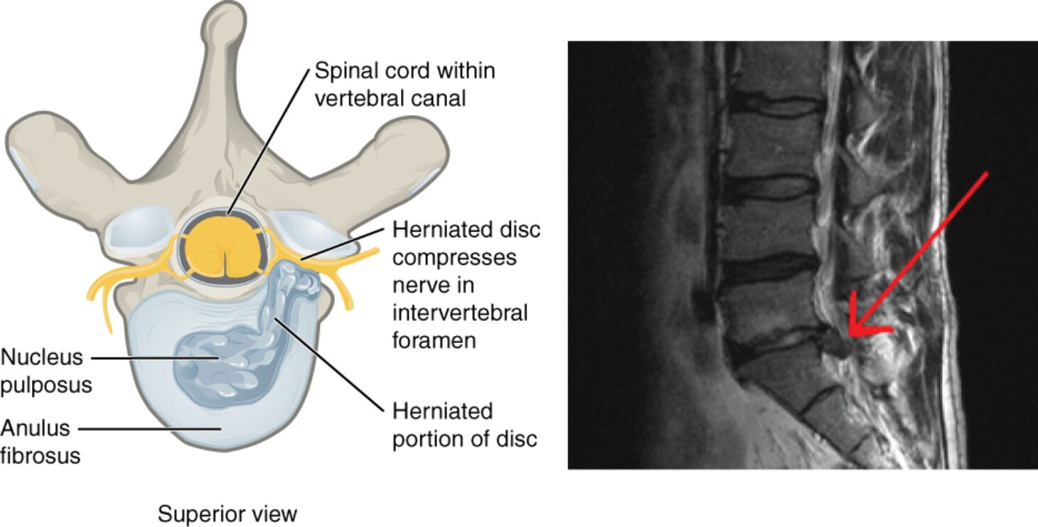 Herniated Intervertebral Disc: Anatomy, Causes, and Treatment of Spinal Nerve Compression