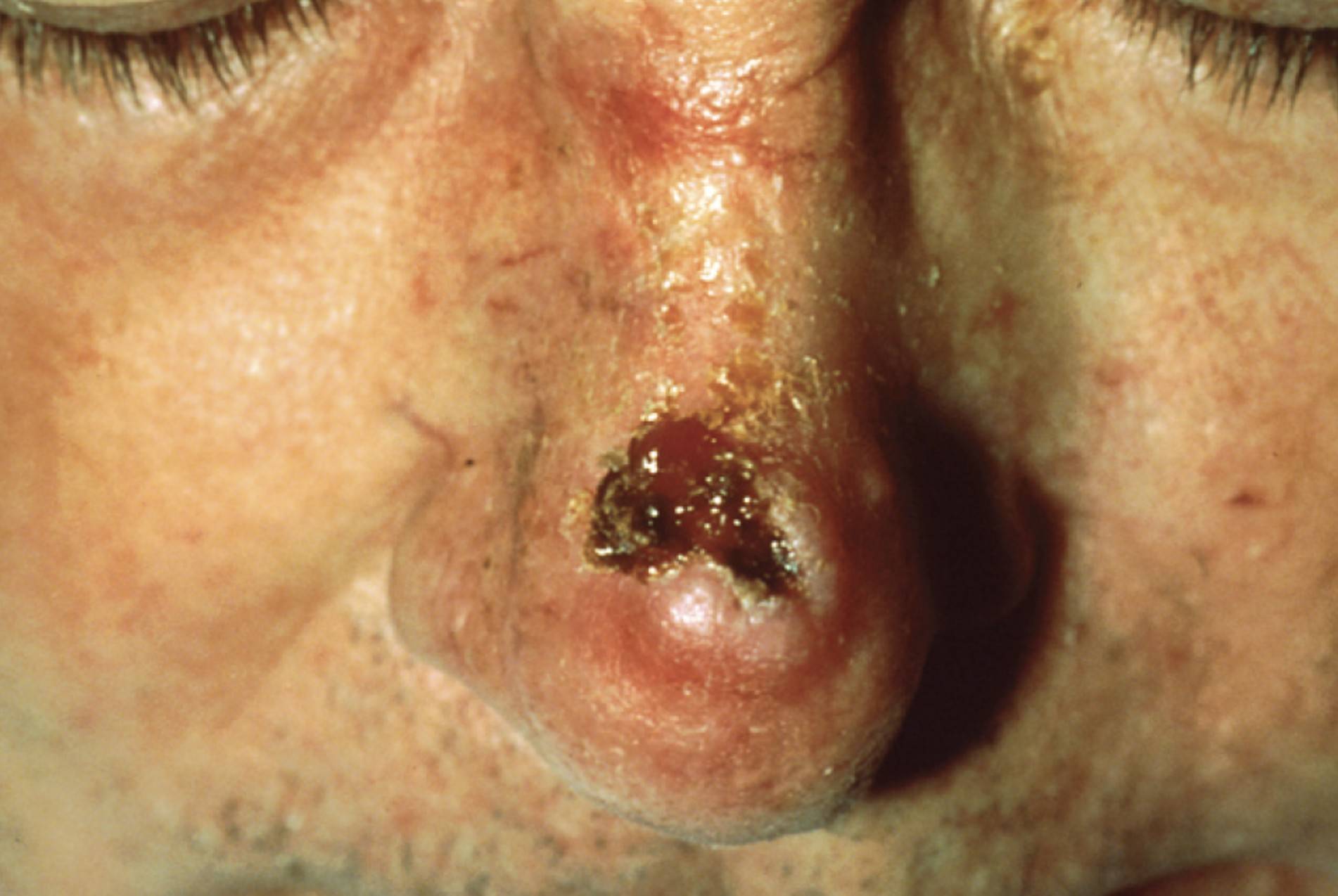 Squamous Cell Carcinoma: Symptoms, Causes, and Treatment of Skin Cancer on the Nose