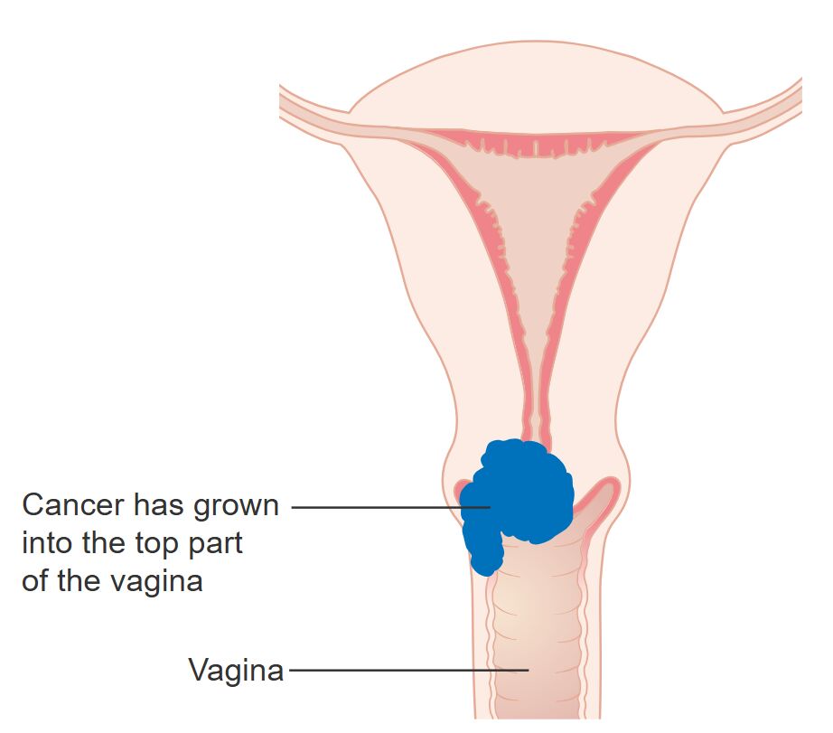 Stage 2A Cervical Cancer: Vaginal Extension and Treatment Approaches