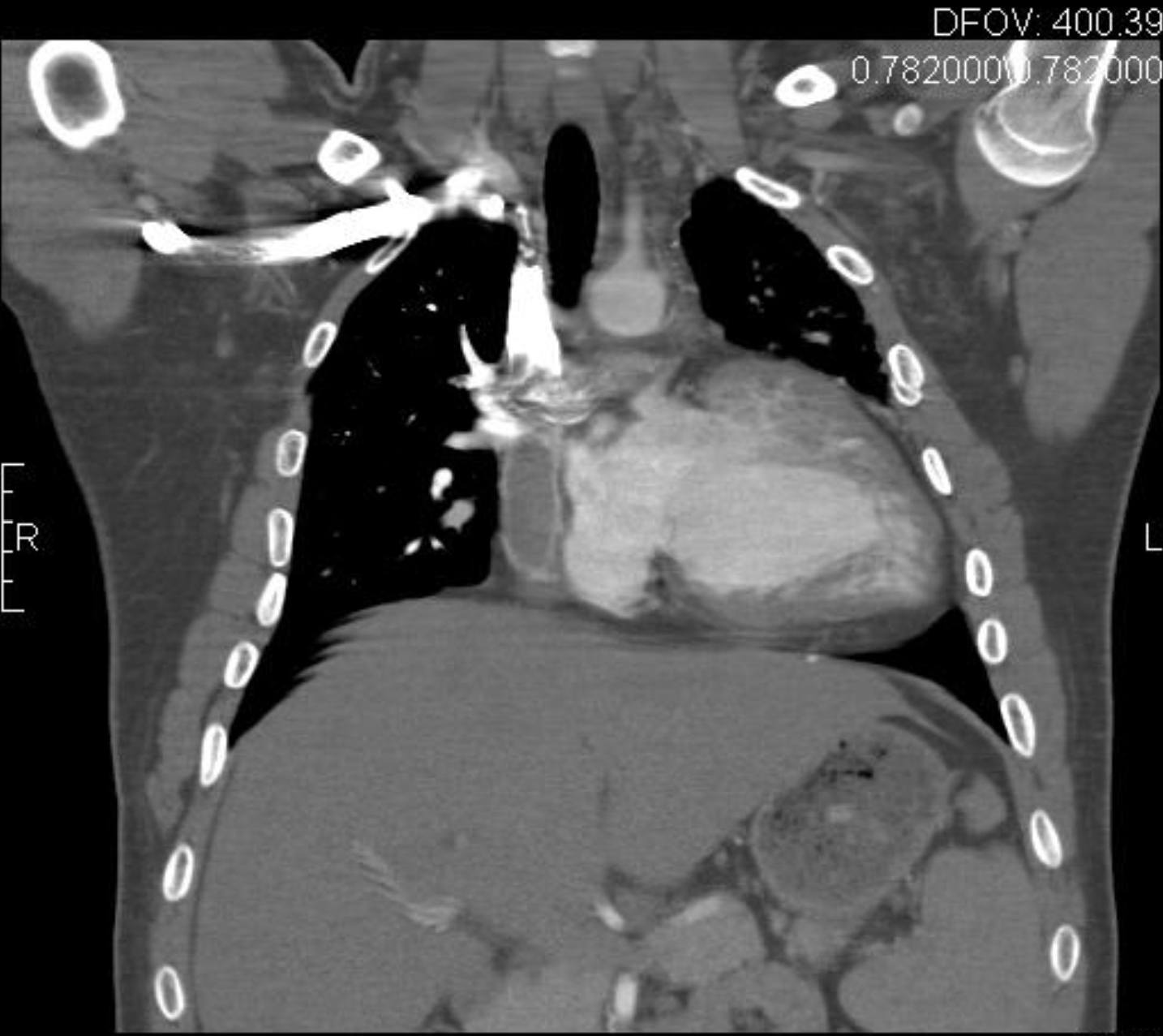 Coronal CT Image of Tricuspid Atresia with Bidirectional Glenn Shunt and Fontan in a 19-Year-Old