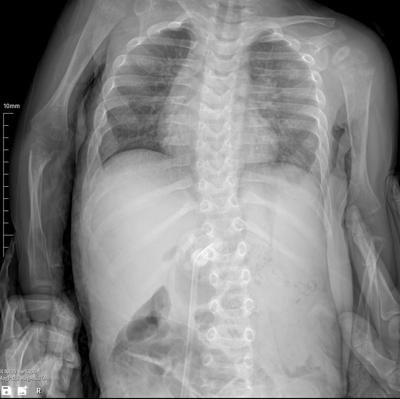 Bronchopulmonary dysplasia (BPD) X-ray image summary, anatomy, findings, differential diagnosis and treatment