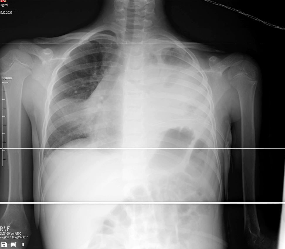 Worsening Pleural Effusion - A Pediatric Case Study: Comprehensive Management of Pleural Effusion in a 6-Year-Old Girl