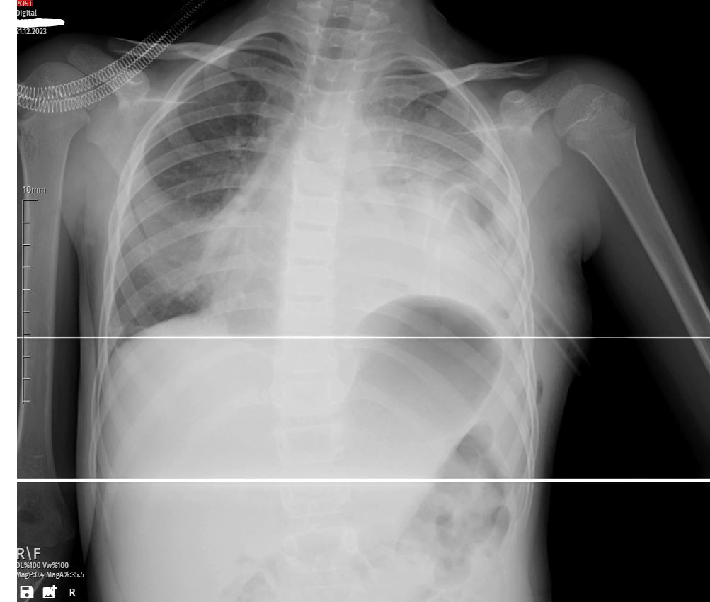 Thoracostomy and Antibiotic Treatment - A Pediatric Case Study: Comprehensive Management of Pleural Effusion in a 6-Year-Old Girl