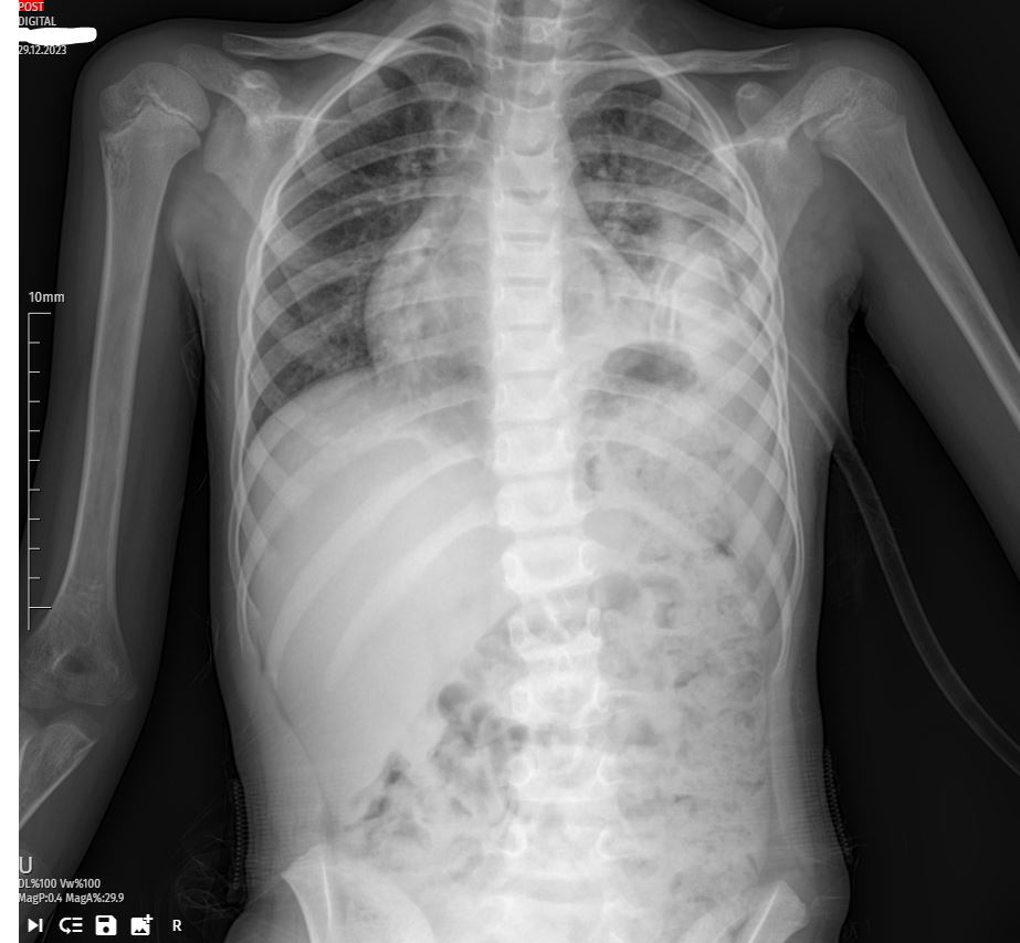 Improvement in Pleural Effusion - A Pediatric Case Study: Comprehensive Management of Pleural Effusion in a 6-Year-Old Girl