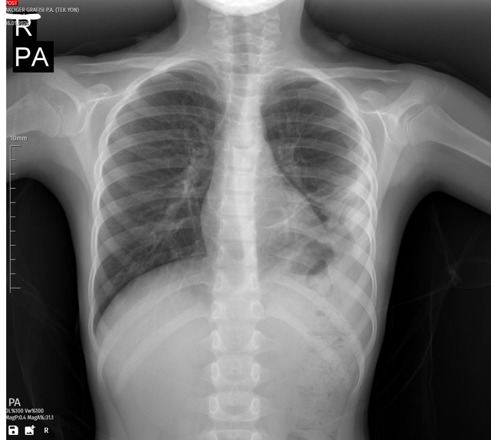 Improvement in Pleural Effusion - A Pediatric Case Study: Comprehensive Management of Pleural Effusion in a 6-Year-Old Girl