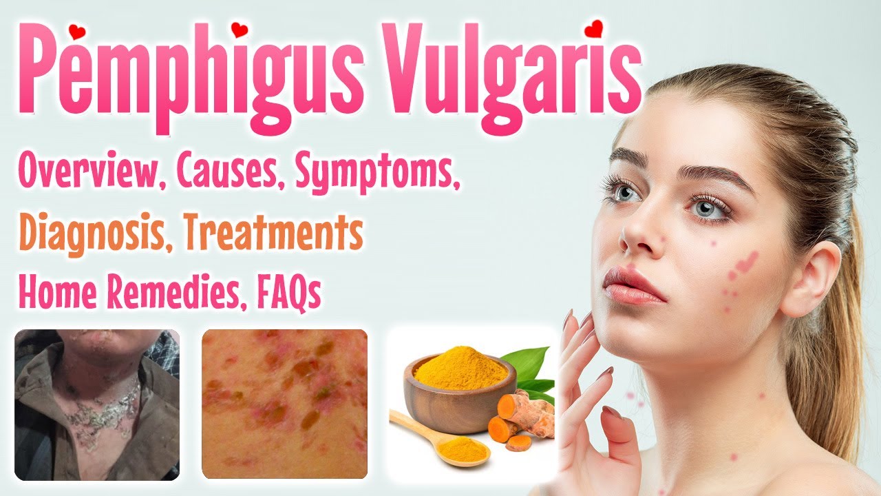 Pemphigus Vulgaris overview, causes, sign and symptoms, diagnosis, treatment, home remedies and FAQs